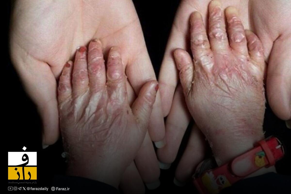 مدیر خانه بیماران پروانهای: بنیاد بیماریهای خاص به ما کمک نمیکند مدیر خانه بیماران پروانهای: بنیاد بیماریهای خاص به ما کمک نمیکند