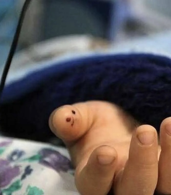 مرگ کودک ۳ ساله همدانی بر اثر روباه‌گزیدگی