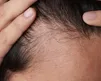 عادت‌های ساده برای جلوگیری از ریزش مو